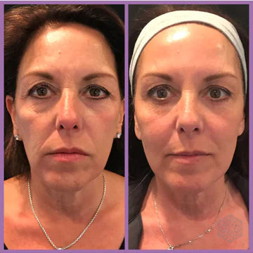Woman in 40s using Beauty Microcurrent Facial Toning Massager Results