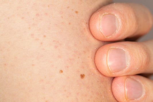 How to Understand and manage Keratosis Pilars (Chicken Skin)