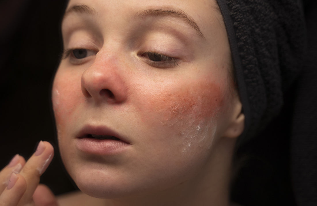 How to Know if your skin is Dry Skin