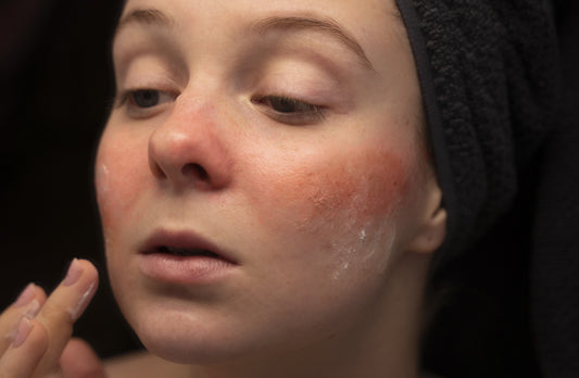 How to Know if your skin is Dry Skin