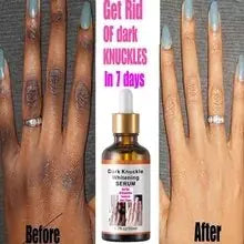 Before and After Intense Knuckle Whitening Serum - DivineLuxes