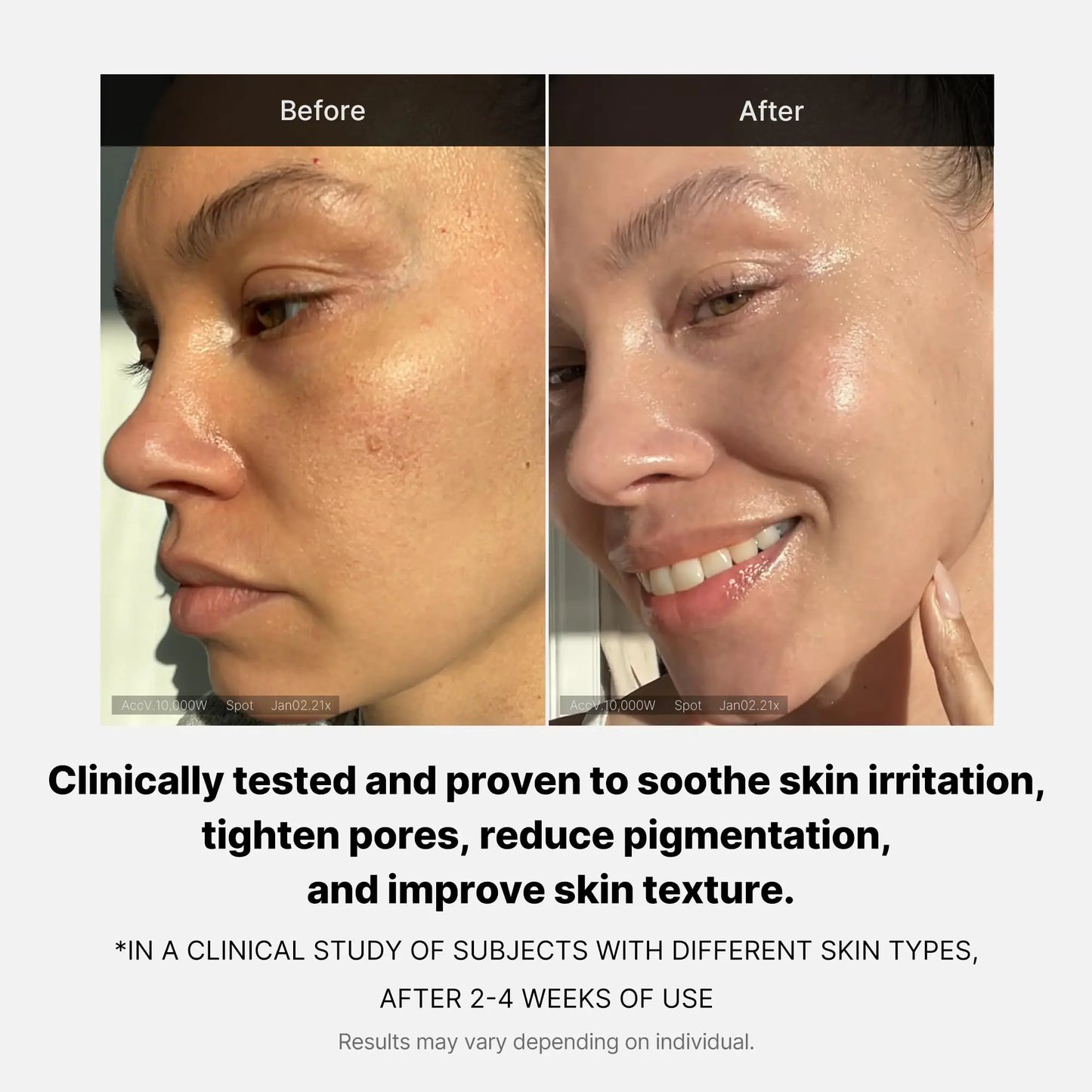 Before and after using Medicube Triple Collagen after 2-4weeks of use Clinically tested and proven to soothe skin Irritation, tighten pores, Reduced Pigmentation, and improve Skin texture