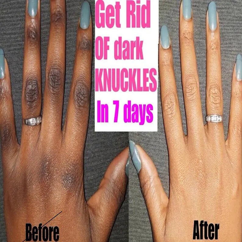 Before and After Using the intense Knuckle Whitening Serum - DivineLuxes